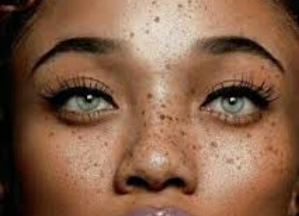 Freckles