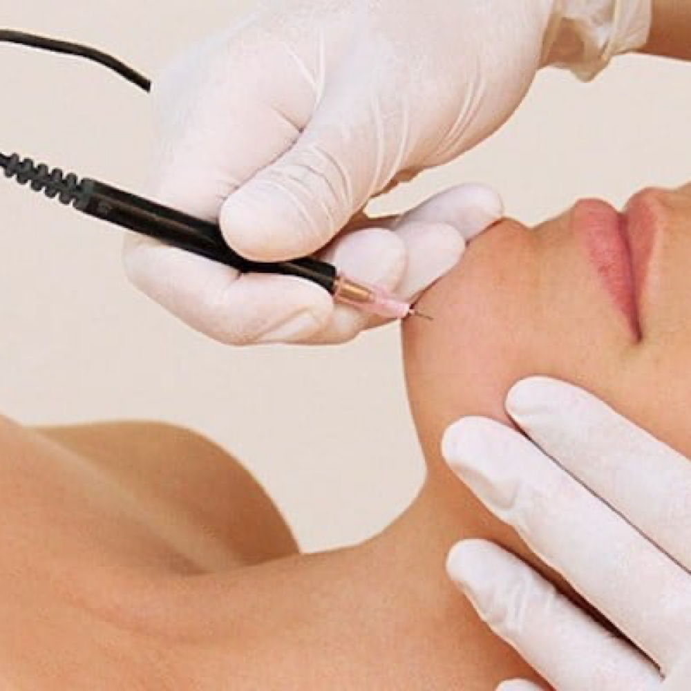 Consultation at Nara’s Electrolysis in Watertown, MA