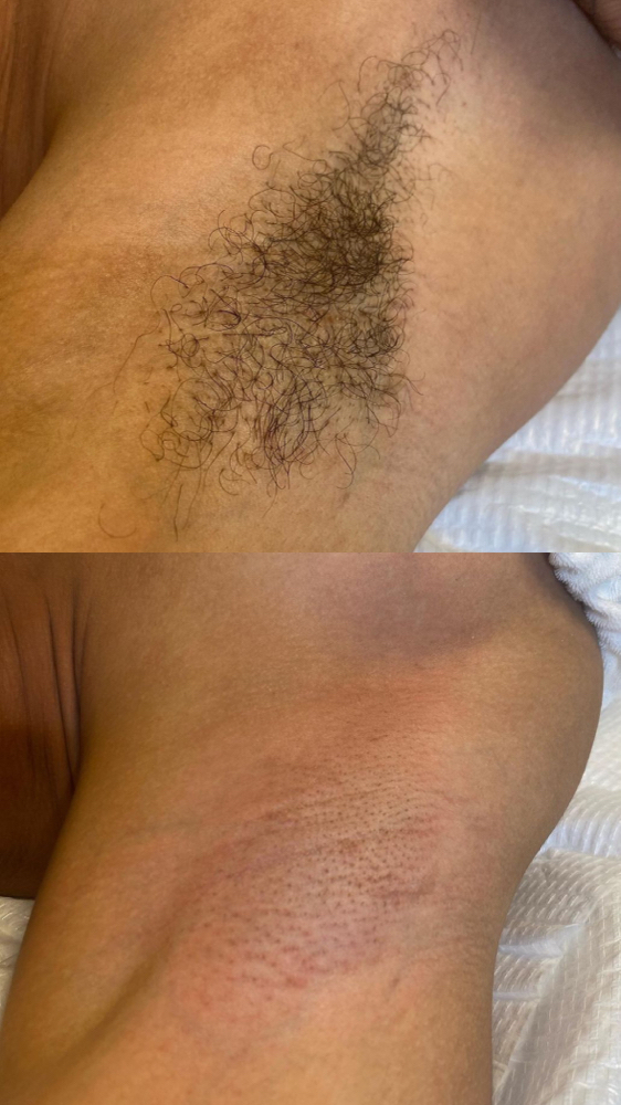 Underarm Wax