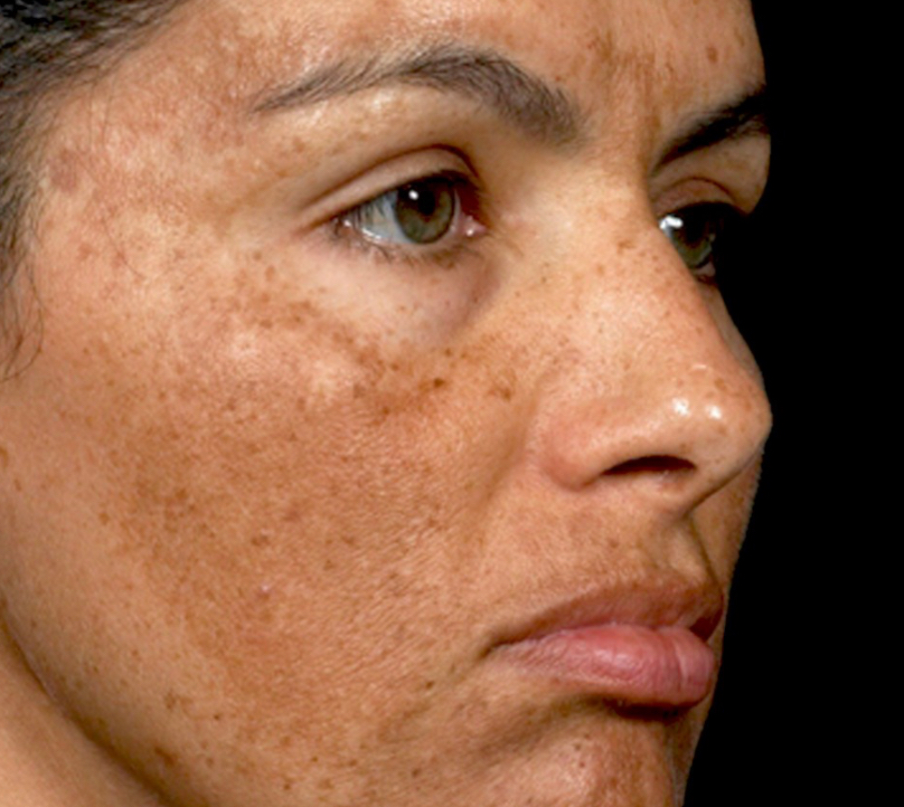 Facial Peeling Targe / Melasma