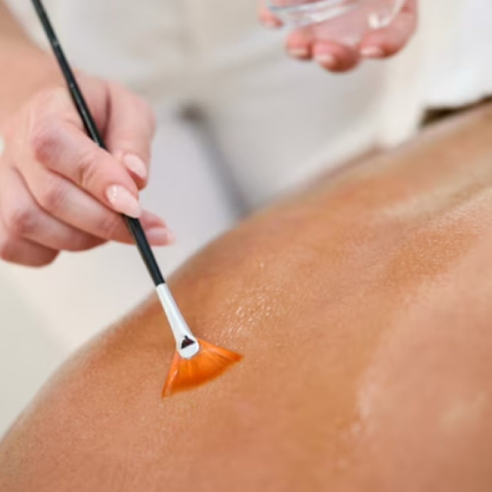 Body Chemical Peel at Esther Esthetics in Suwanee, GA