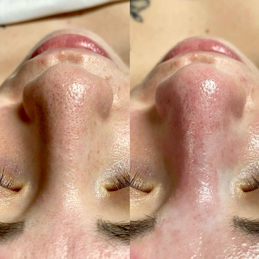 Extractions