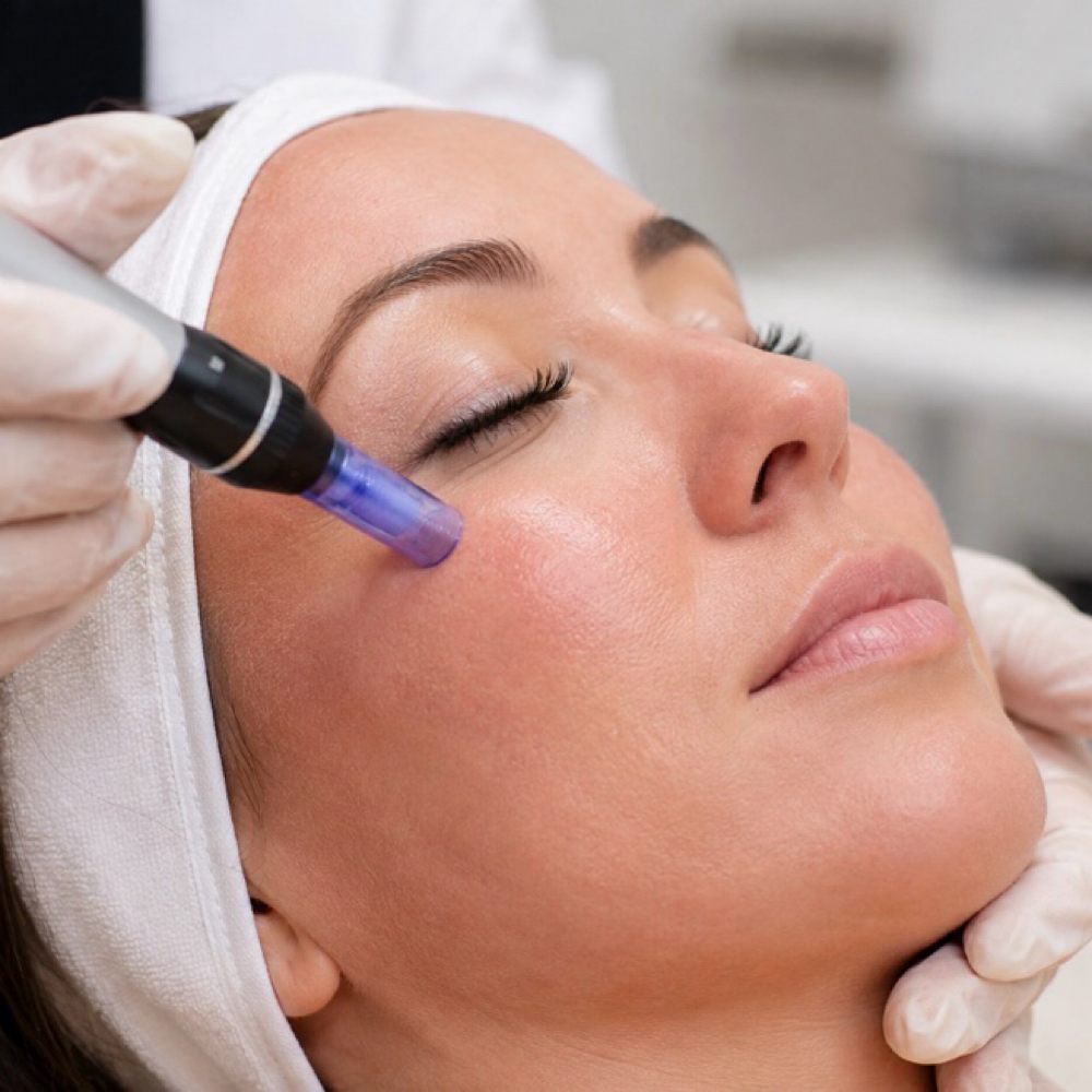 Microneedling Treatment at Tel’s Beauty Spa in Richmond, TX