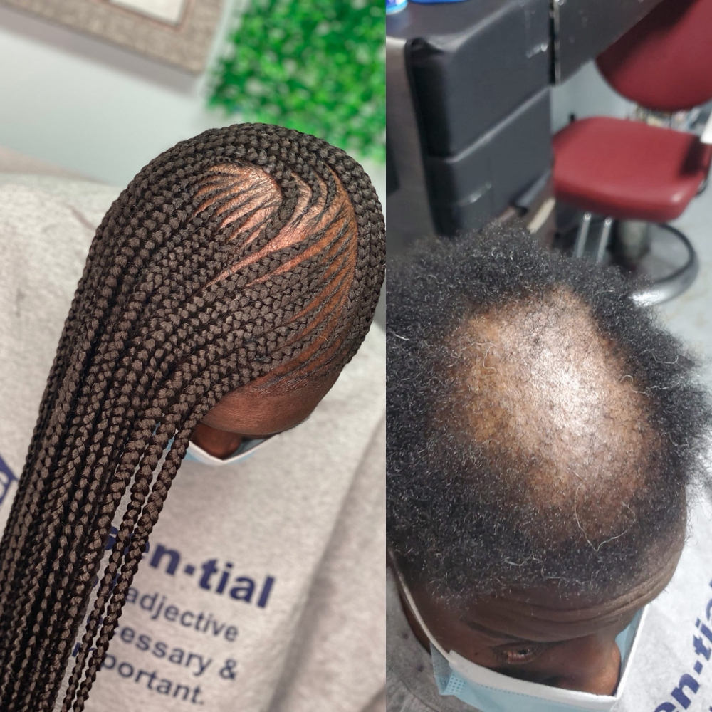 Alopecia Consultation at Tobs braiding salon llc in Houston, TX