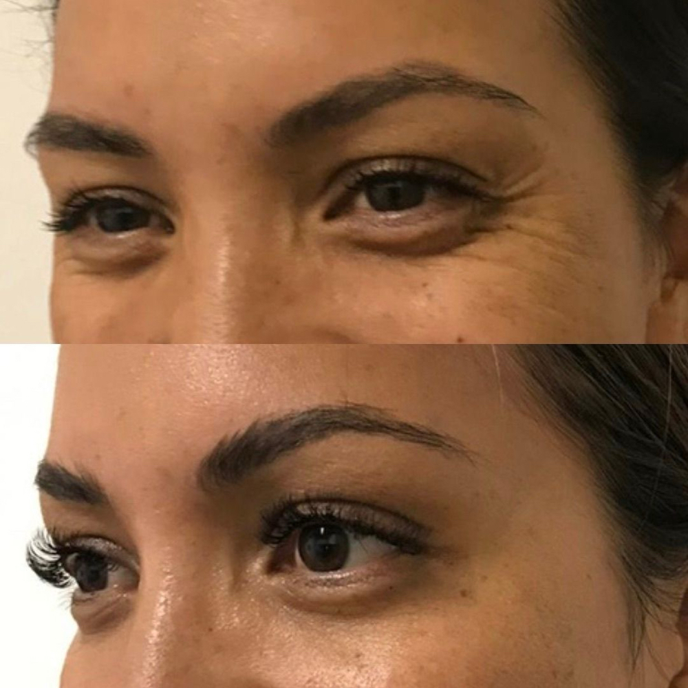 Botox for Crow’s Feet at La Belle Aesthetics & Wellness in Hellertown, PA
