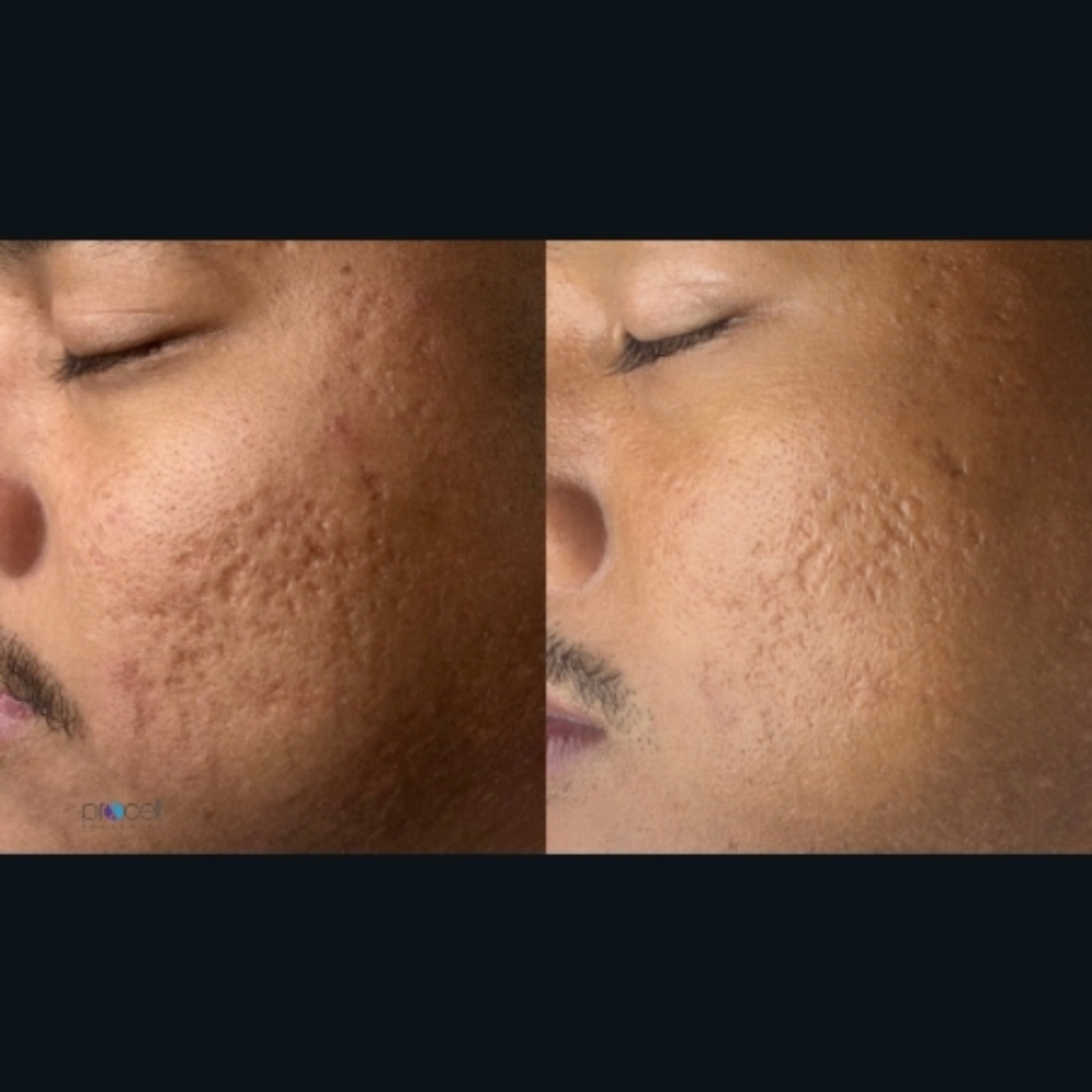 Microchanneling at Basic and Beyond Brows in Lakewood, CA