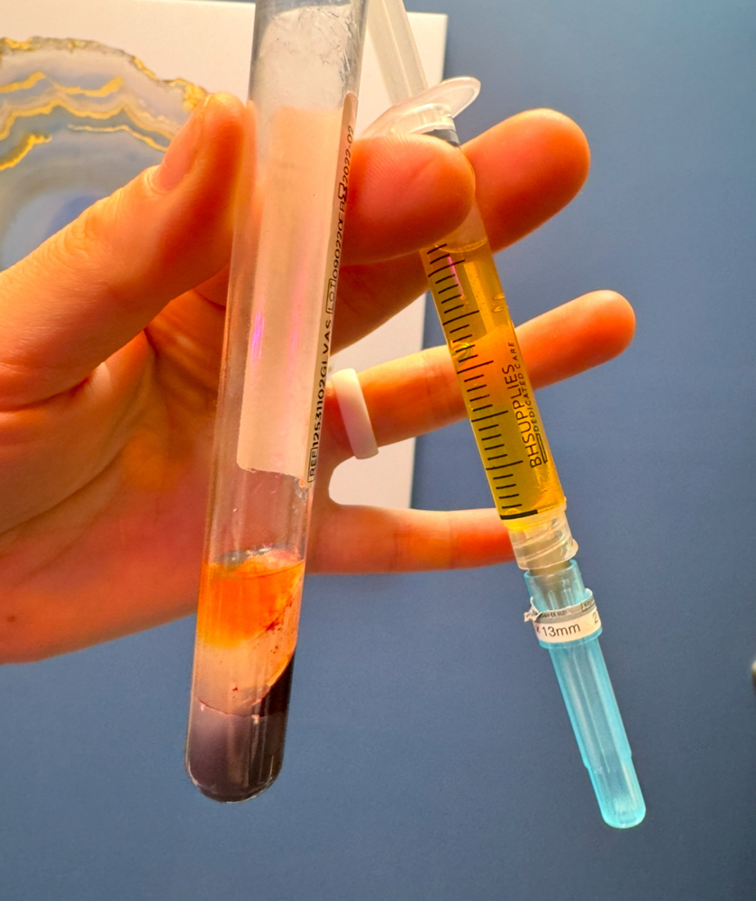 PRP Microneedling Facial