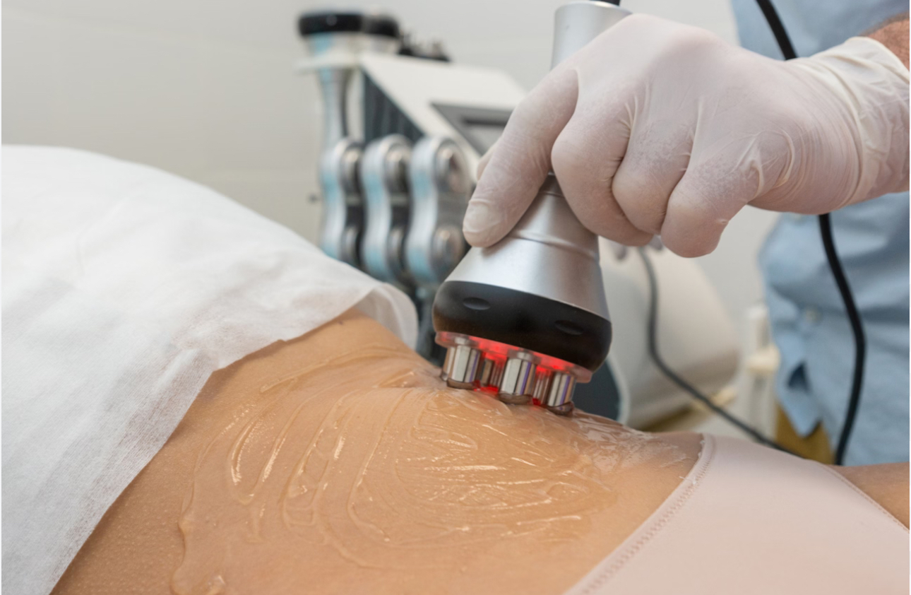 Radio Frequency Body Cavitation