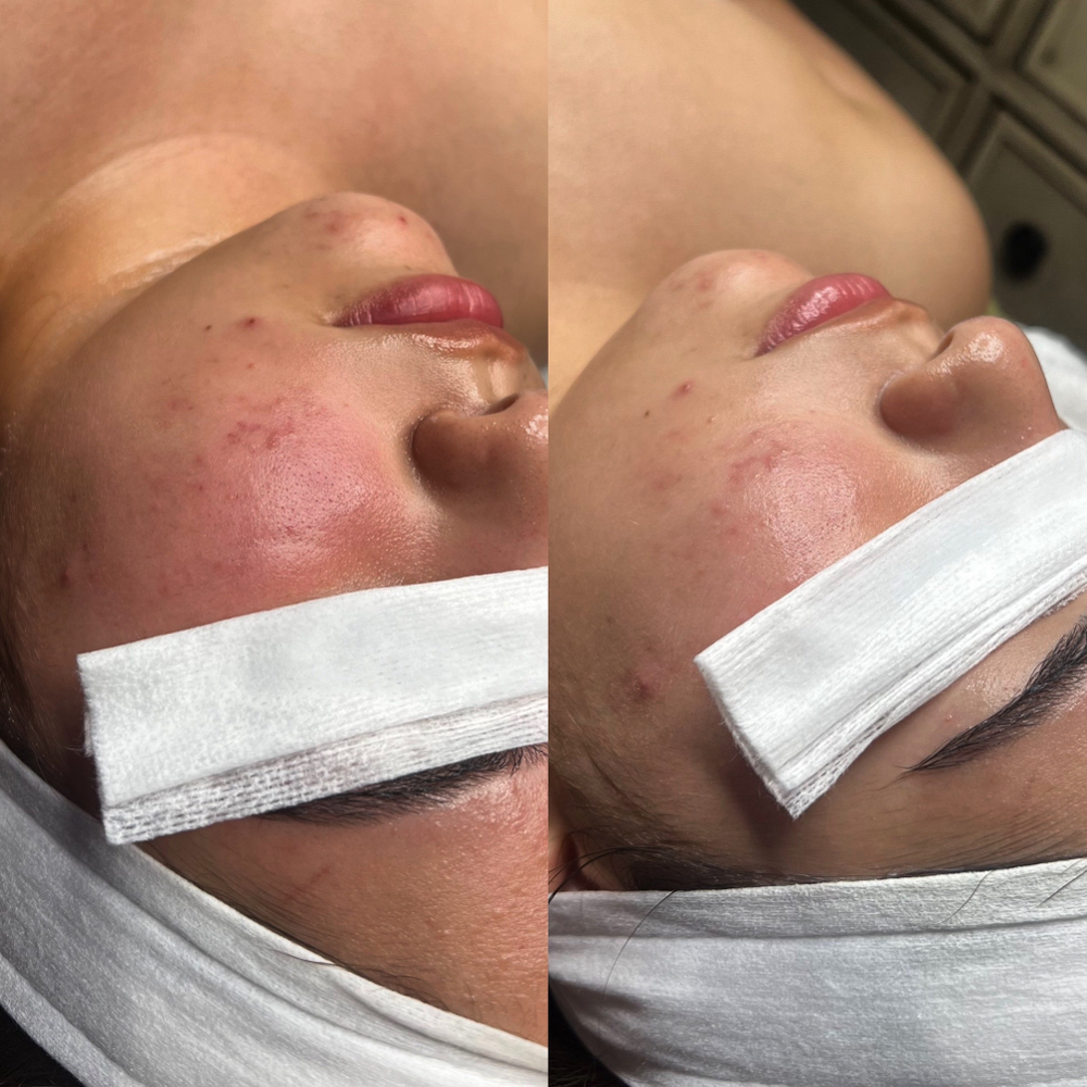 🧖🏻‍♀️ FACIALS 🧖🏻‍♀️