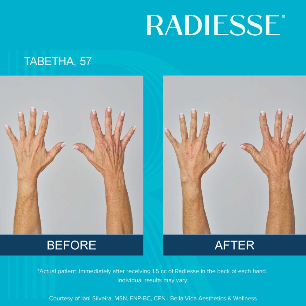 Radiesse Hand Treatment at All Things New Med Spa in Pollok, TX