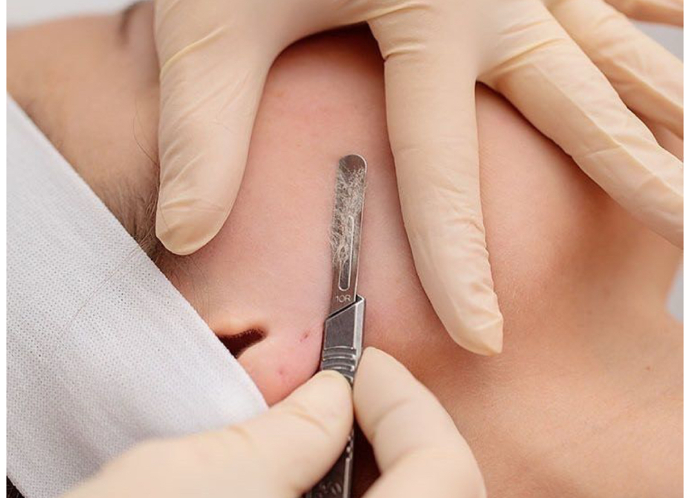 Dermaplaning Treatment