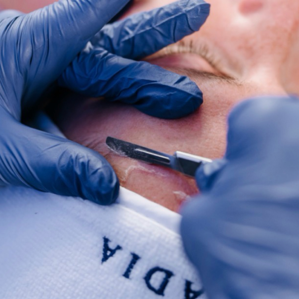 Dermaplane Glow Facial at Paradise Esthetics in Hacienda Heights, CA