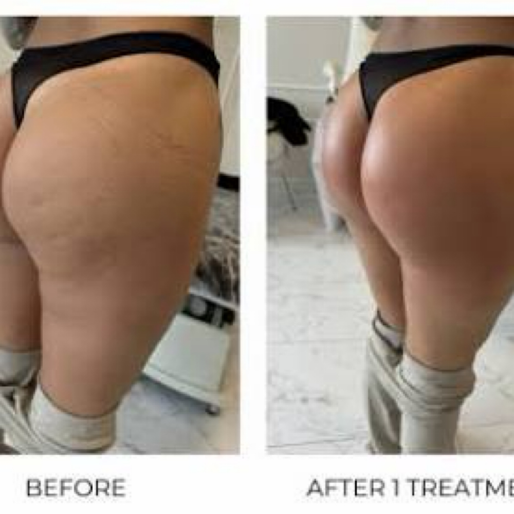 Artemis T- Shape 2 - Buttocks at Mirrored Image Beauty & Wellness in Oconomowoc, WI