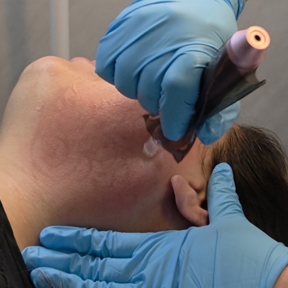 Lavish Elite SkinPen Microneedling at Lavish Face & Skin SPA LLC / Med Spa in San Antonio, TX