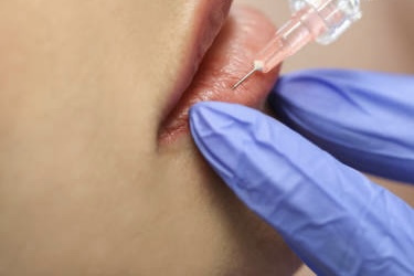 Lip Fillers at Milk & Honey Aesthetics in Sugar Land, TX