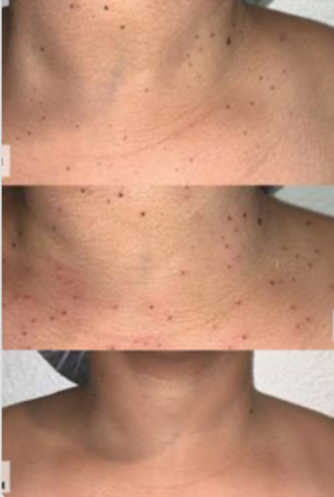 DPN Skin Tag/Milia/Cherry(Full Neck