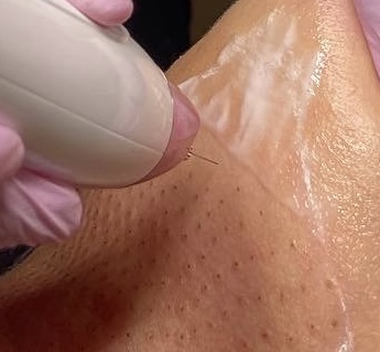 FIBROBLAST PLASMA PEN CONSULTATION at Skin & Soul Skincare LLC in Tucson AZ, AZ