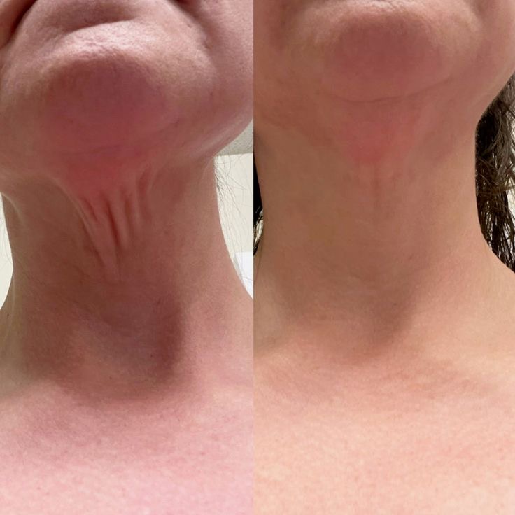 Neck And Décolleté at Charismatic Beauty in Apple Valley, CA