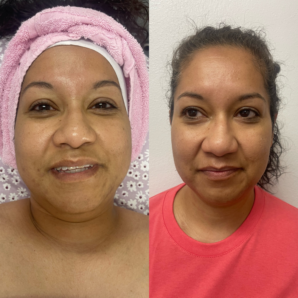 Customized Facial