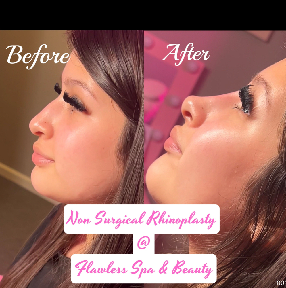 💎 NOSE FILLER at Flawless Spa & Beauty in Fort Worth, TX