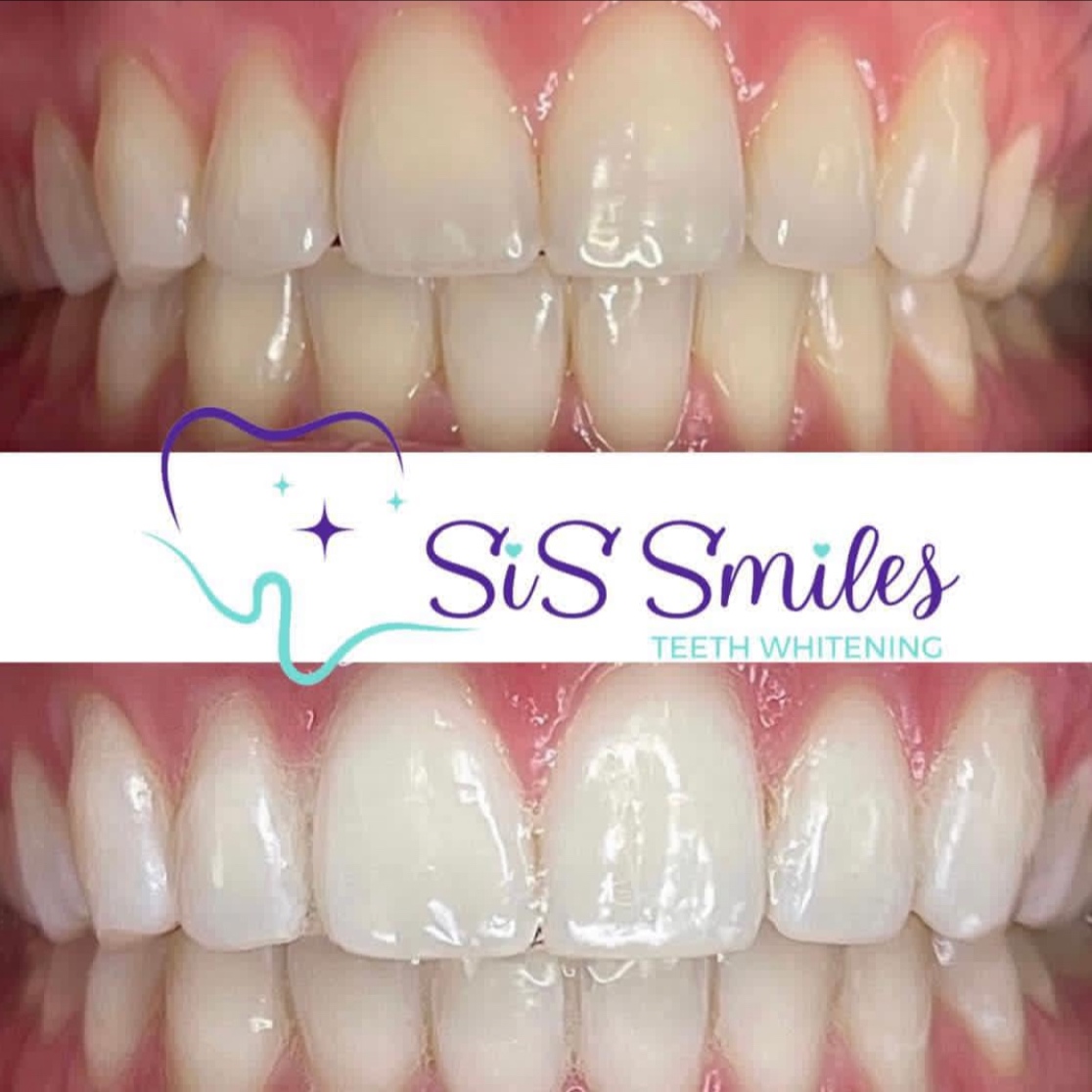 Teeth Whitening at Lush Cryo and Wellness in Reno, NV