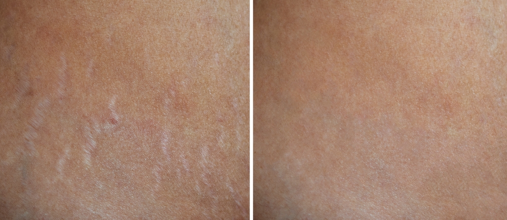 Inkless Stretchmark Revision (ISR)