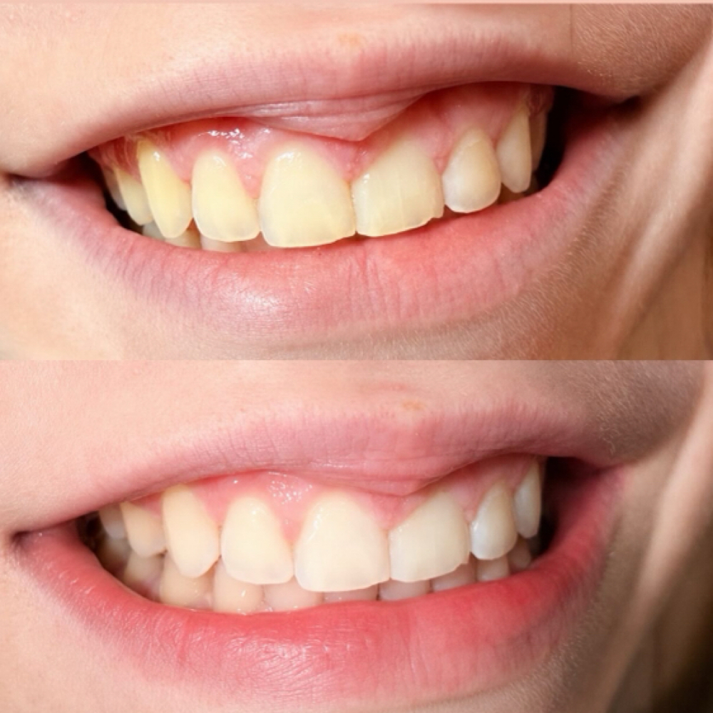 Teeth Whitening Monday at Yesenia’s Fit Glow in Richlands, NC