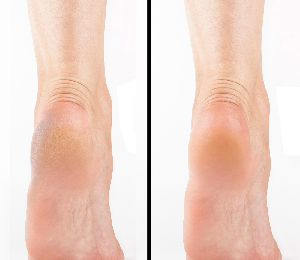 Callus Remover