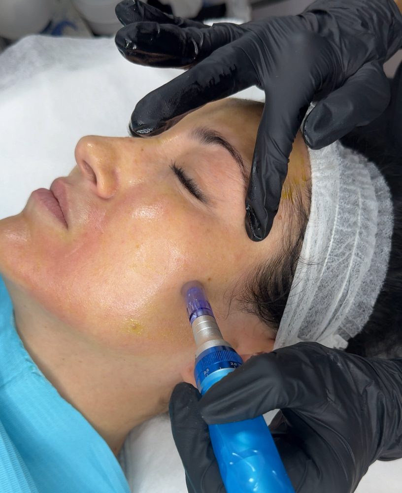 BioRePeel with Microneedling 4 sess
