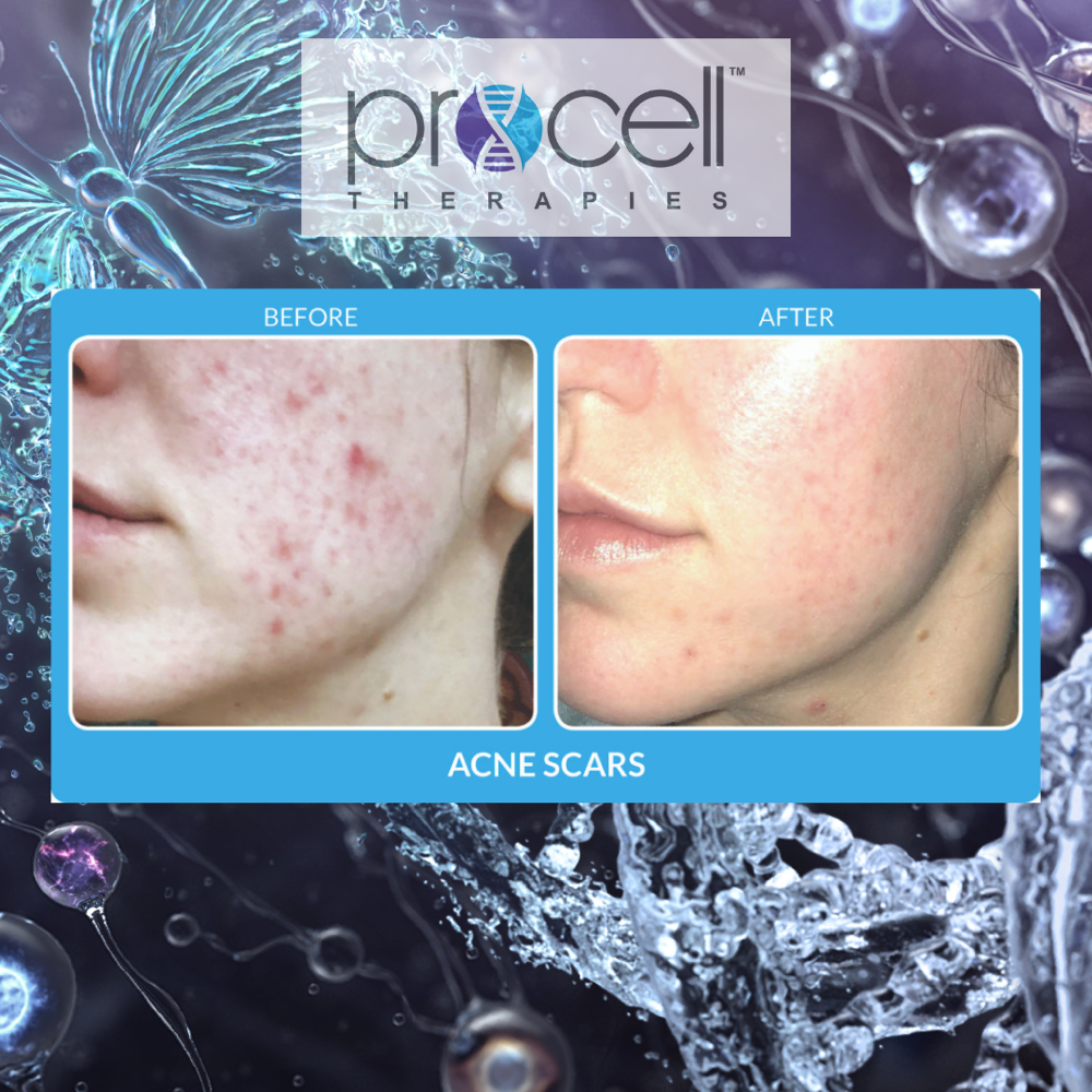 Procell Microchanneling Series Of 3 at Serenity Skin Lounge in Deptford, NJ