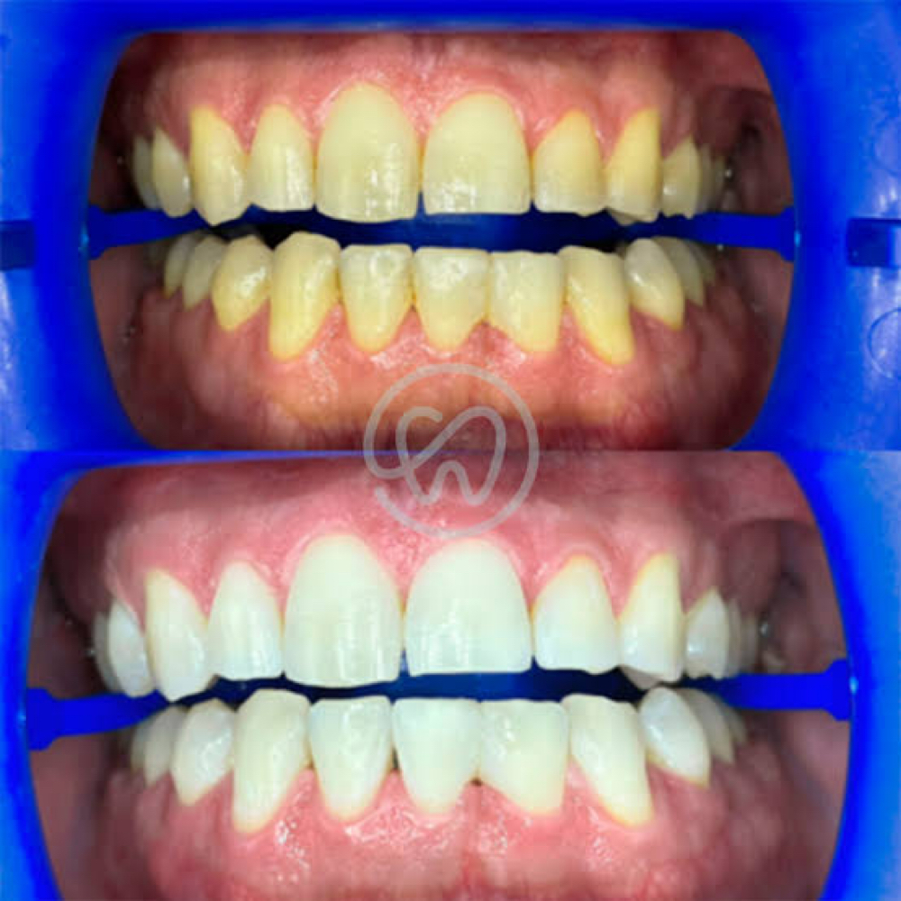 Laser Teeth Whitening at LUSTer Wellness in Frisco, TX