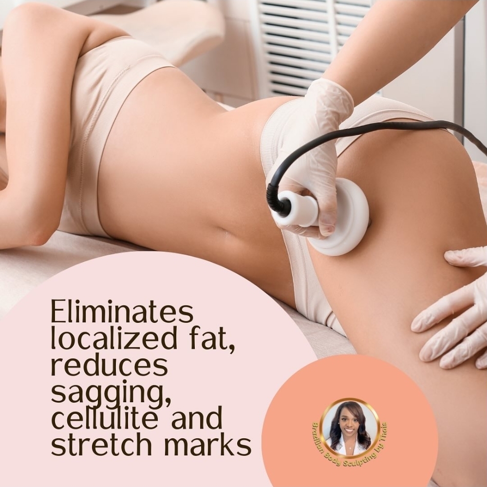 Cellulite Vellashape Treatment