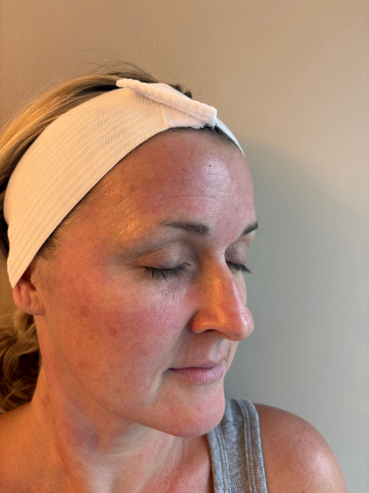 Microneedling at A.L aesthetics in Dawsonville, GA