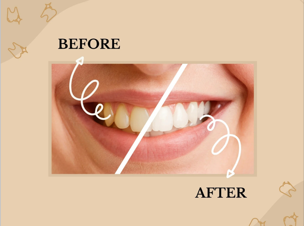 Teeth Whitening
