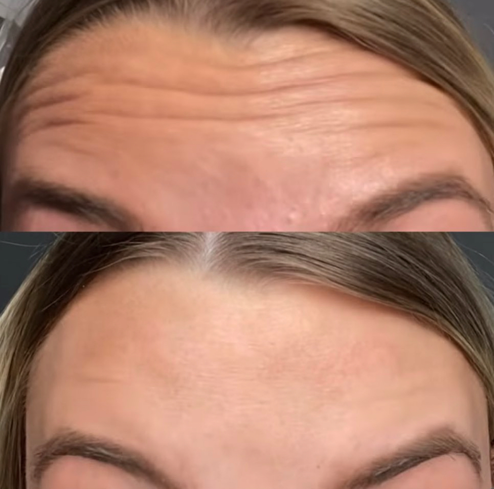 Botox ( Foreahead)