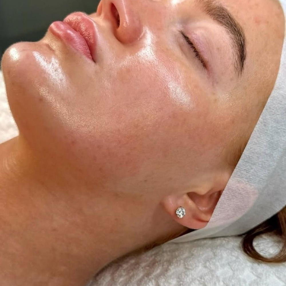 Chemical Peel Treatment at Destiny Aesthetics in Boise, ID