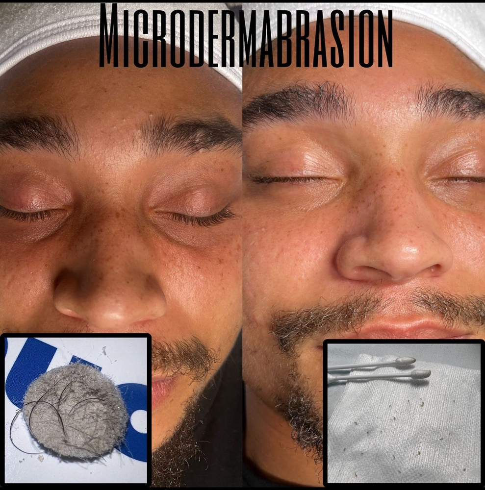 Microdermabrasion +Hydrojelly Mask