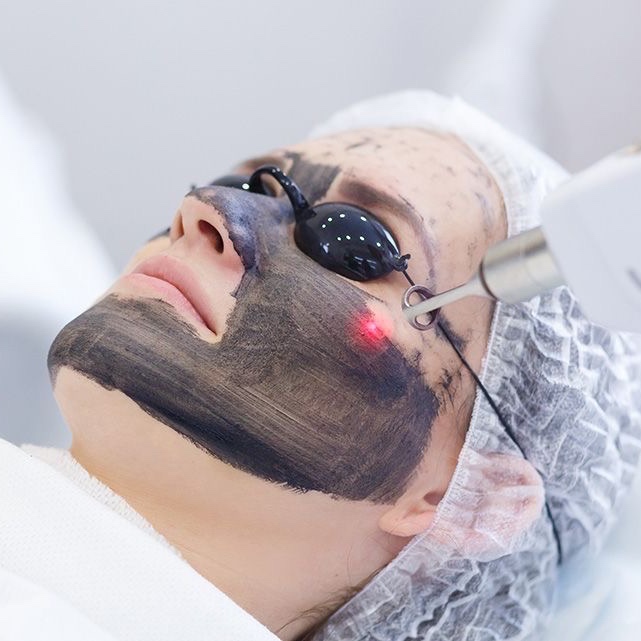 CARBON PEEL at Remake Beauty Studio Mission in Mission, TX