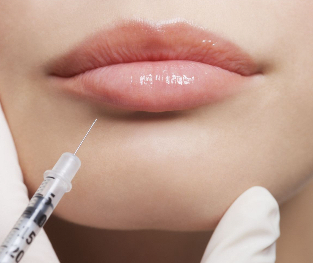 Lip Filler 1/2 Syringe