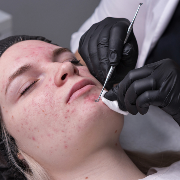 Acne Facial