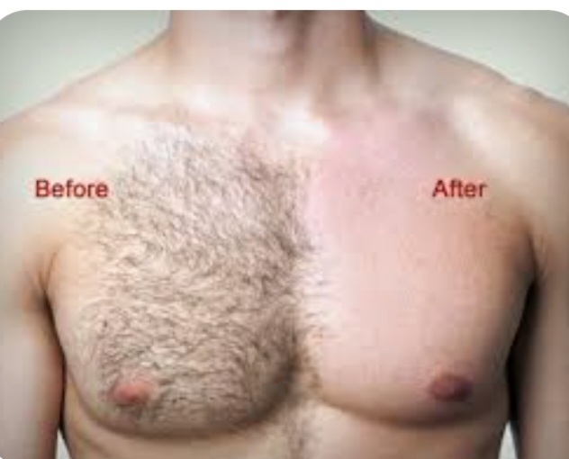 Laser hair Chest