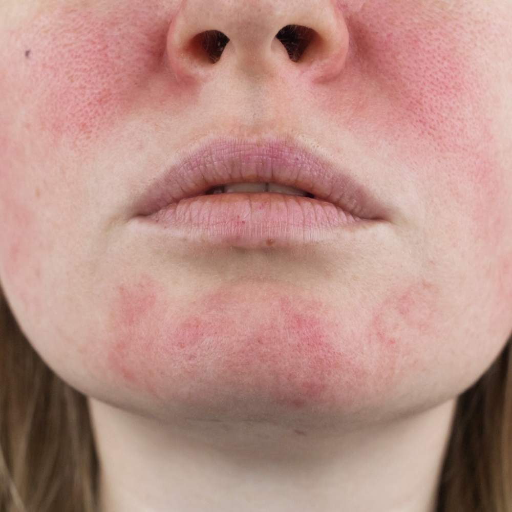 Soothing Redness/Rosacea Treatment