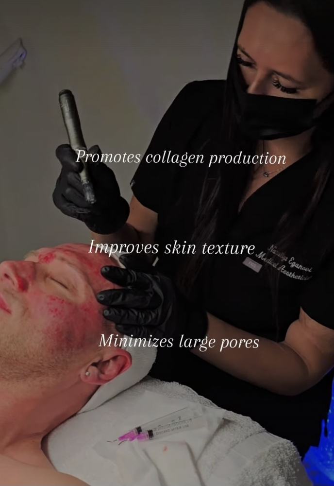 PDRN Salmon DNA Microneedling