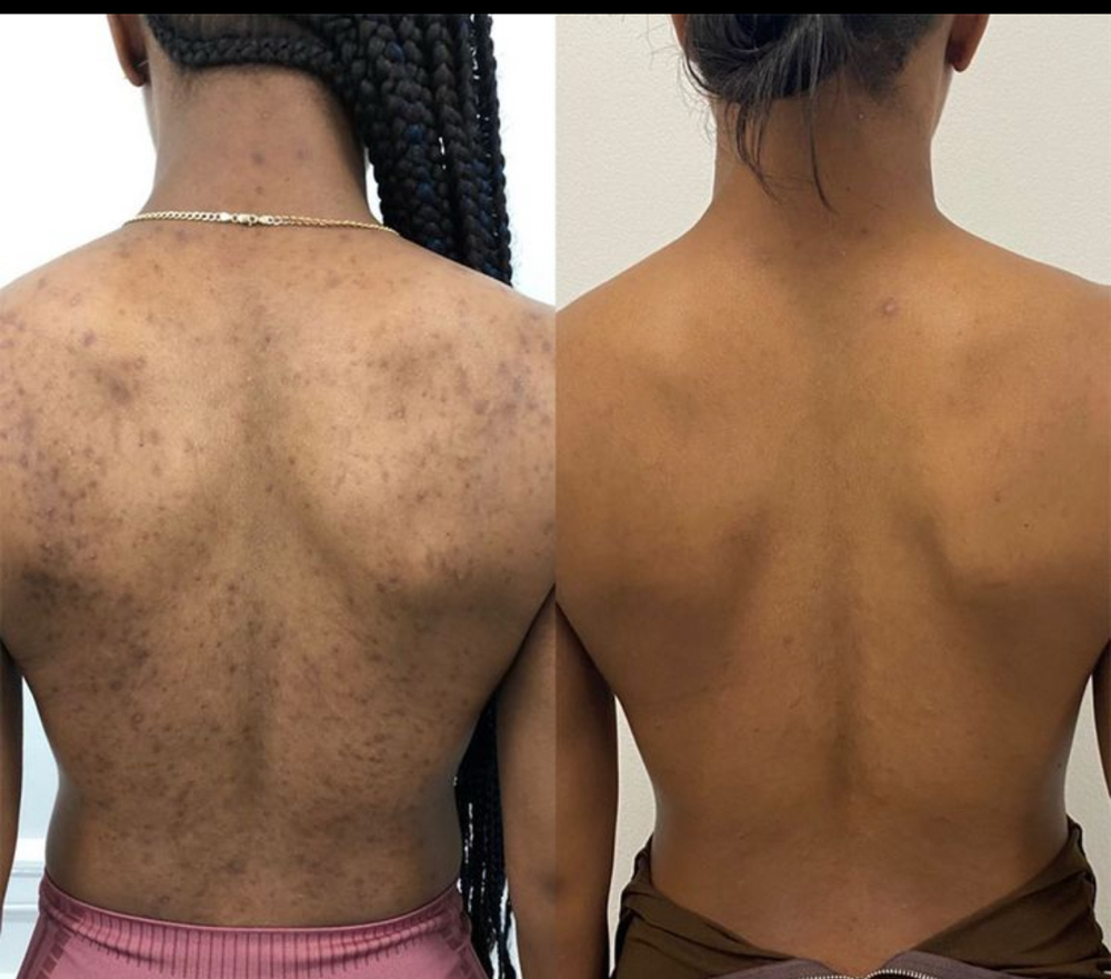 BACK FACIAL