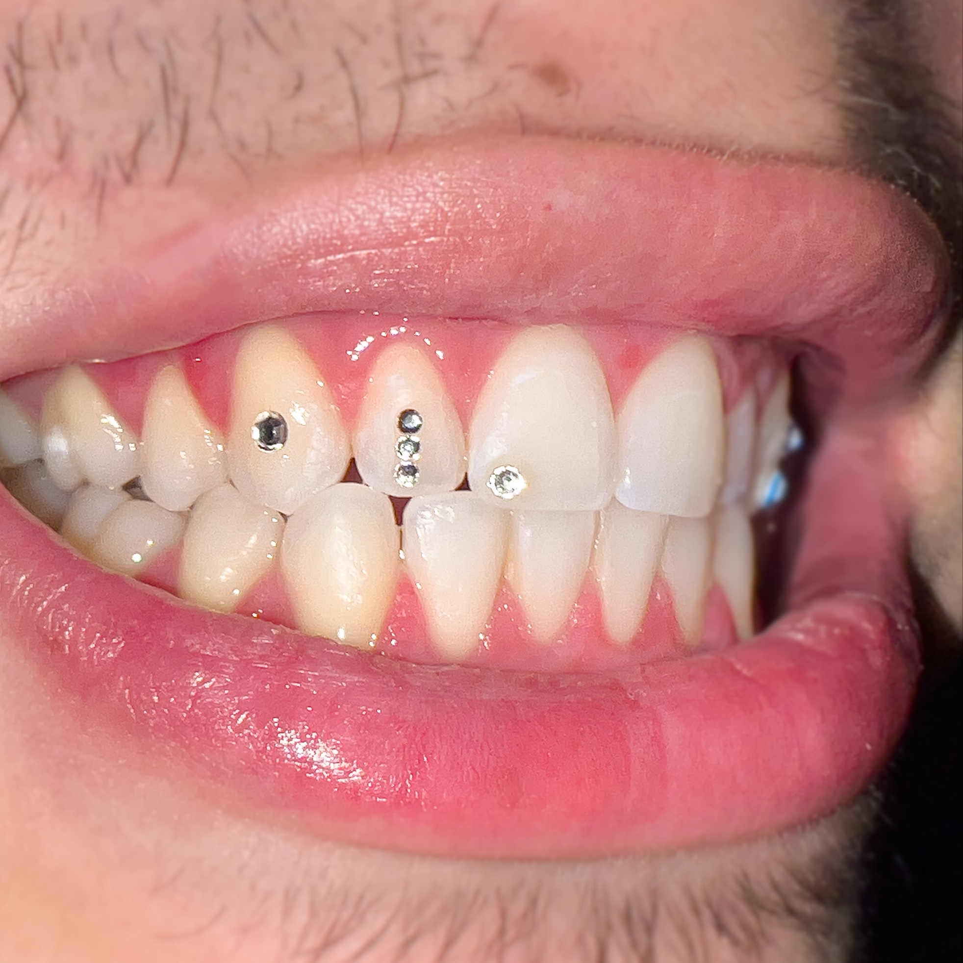 SMALL CLASSIC DESIGN at PsychoTeeth in manhattan, NY