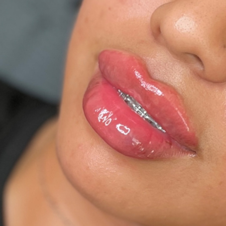 1 Syringe Lip Filler