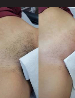 Bikini Wax