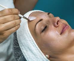 Chemical Peel