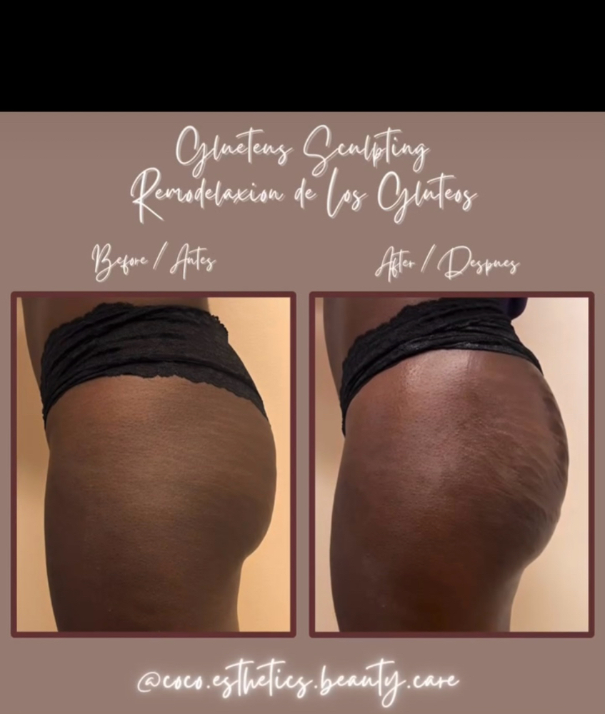 Gluteus Sculpting