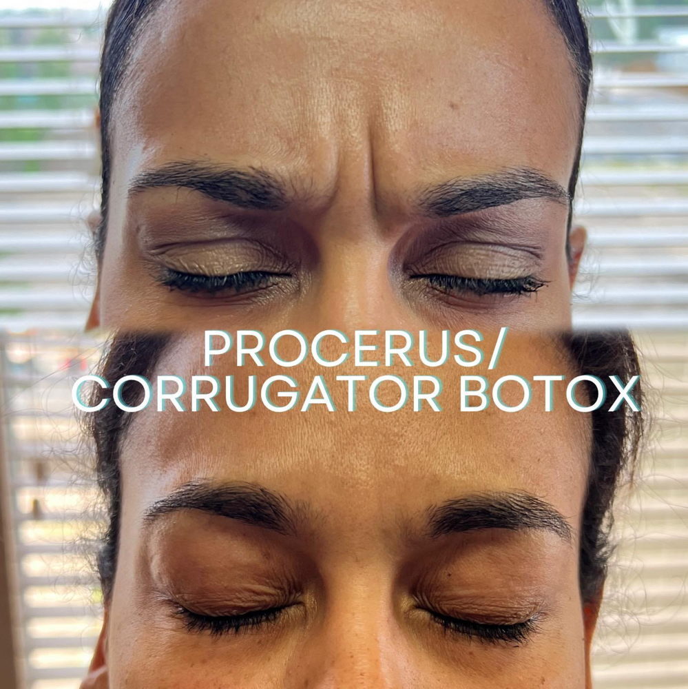 Tox- 11’s ONLY💉 at BeautyHolic Aesthetics LLC in Lubbock, TX